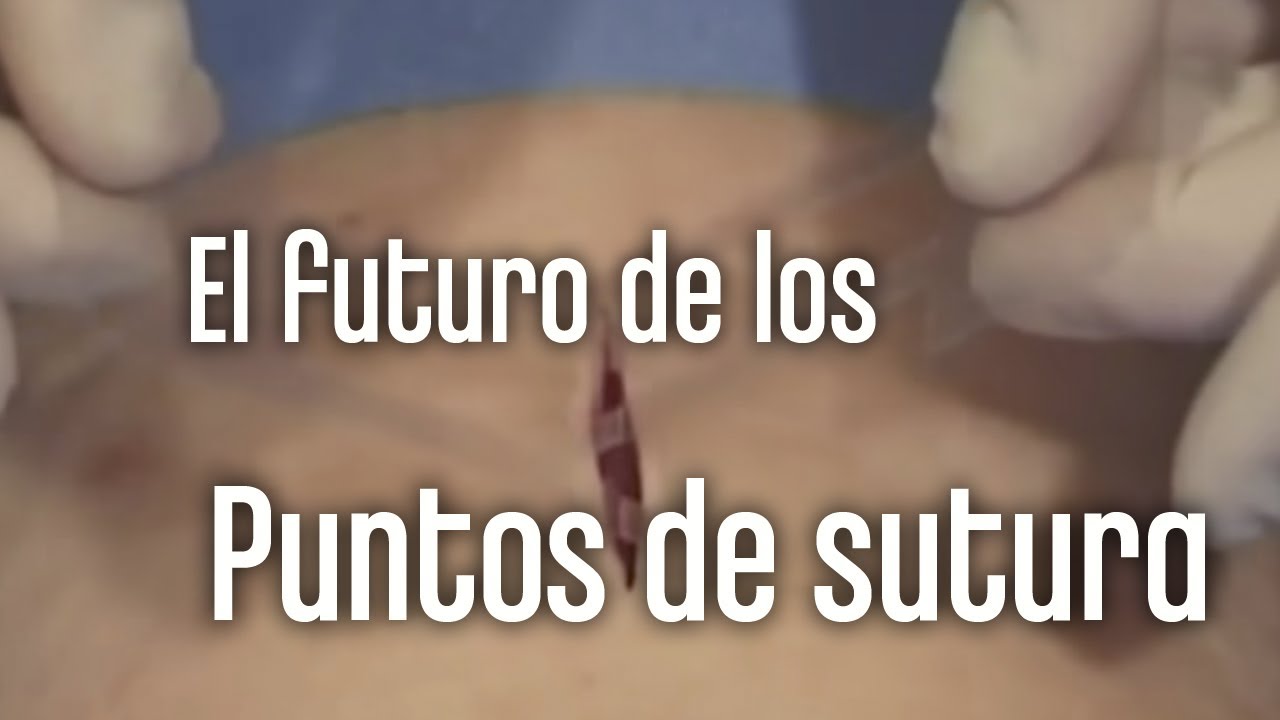 Compensación por lesiones faciales que requirieron puntos de sutura